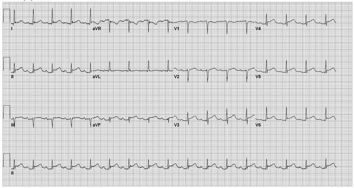 figure pericarditis