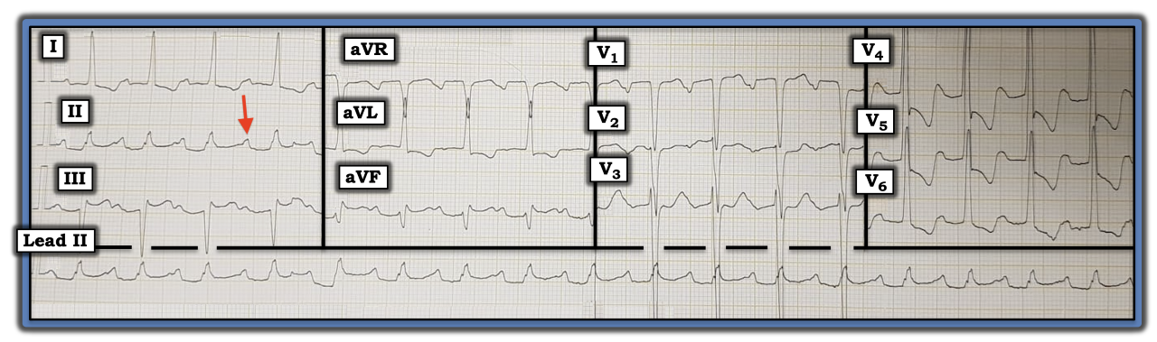 thumbnail_Figure-ECG-Review-363-(5-31.21-2021)-Jonathan.png