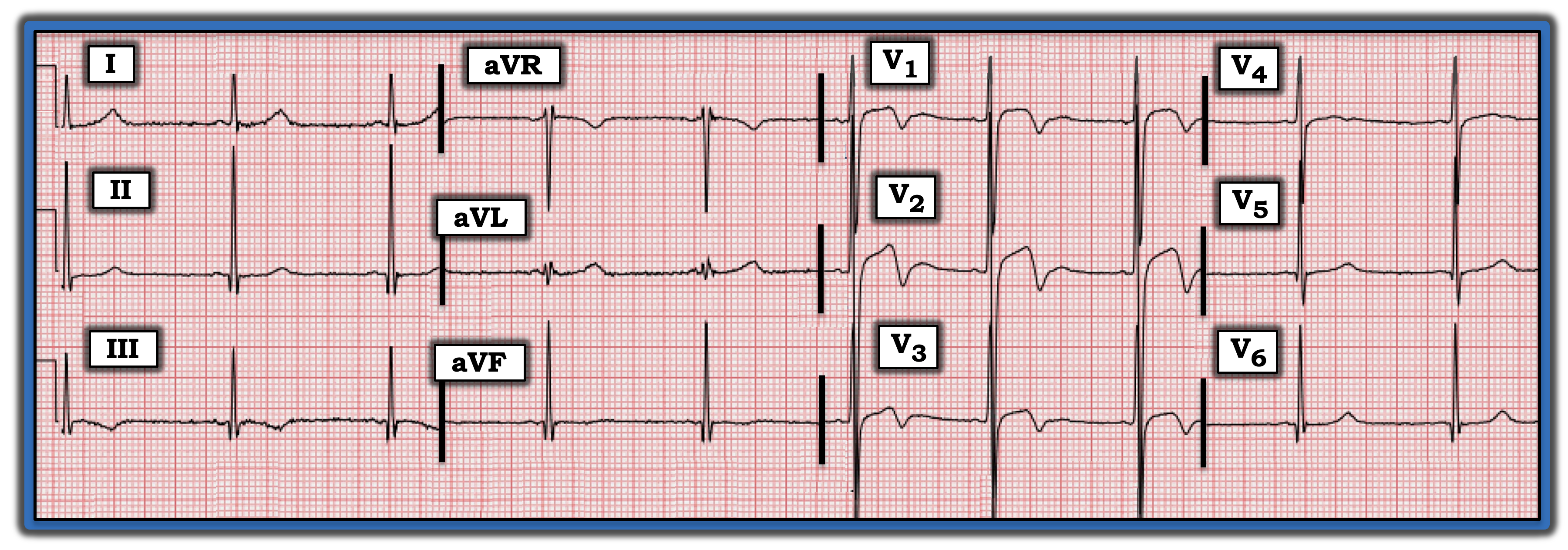 Figure-ECG-Review-364-(10-3.21-2021)-Jonathan.png