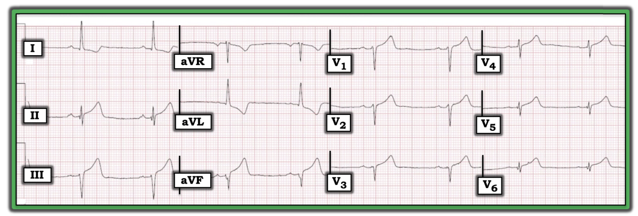 ECG Review 367 Figure.png