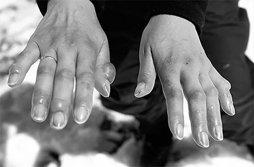 TR050122 frostbite web.jpg