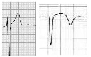 Figure 2_Fig 2 ST segment concave and convex bw.jpg