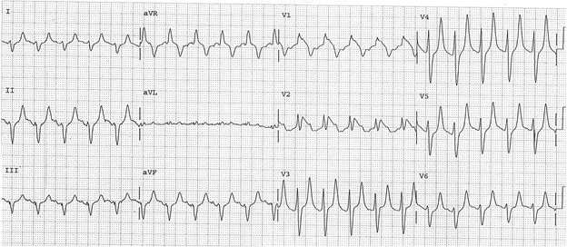 Figure 5_STEMI mimics fig 5 hyperkalemia.jpg