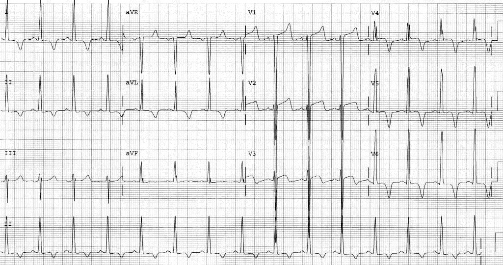Figure 7_New Figure 8 - Left Ventricular Hypertrophy.jpg