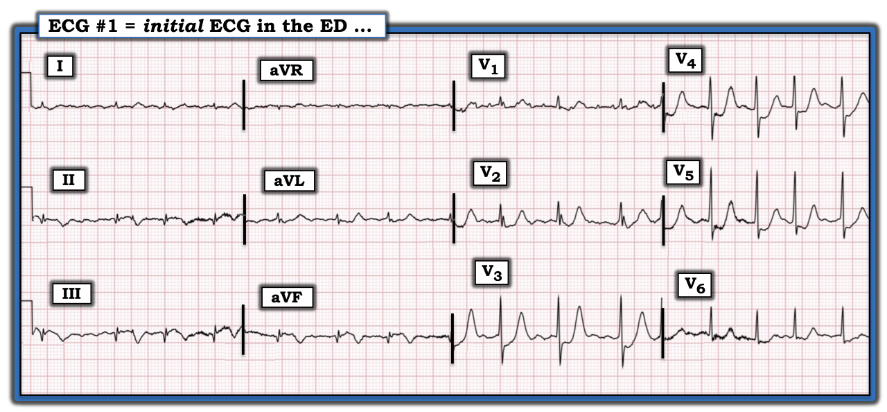 ECG Review-369 Figure.png