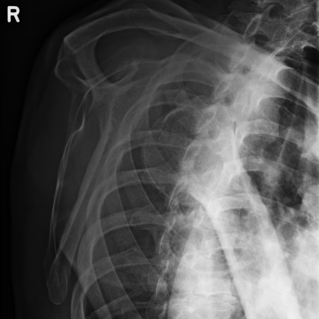 Anterior shoulder dislocation