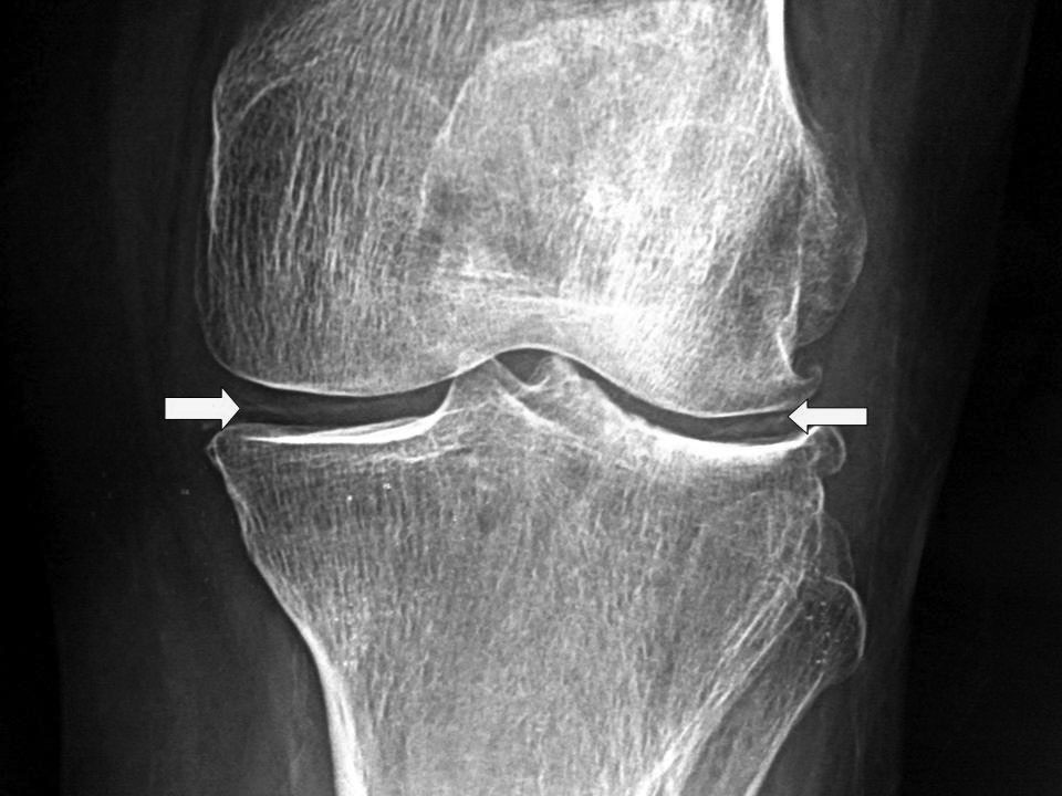 Chondrocalcinosis
