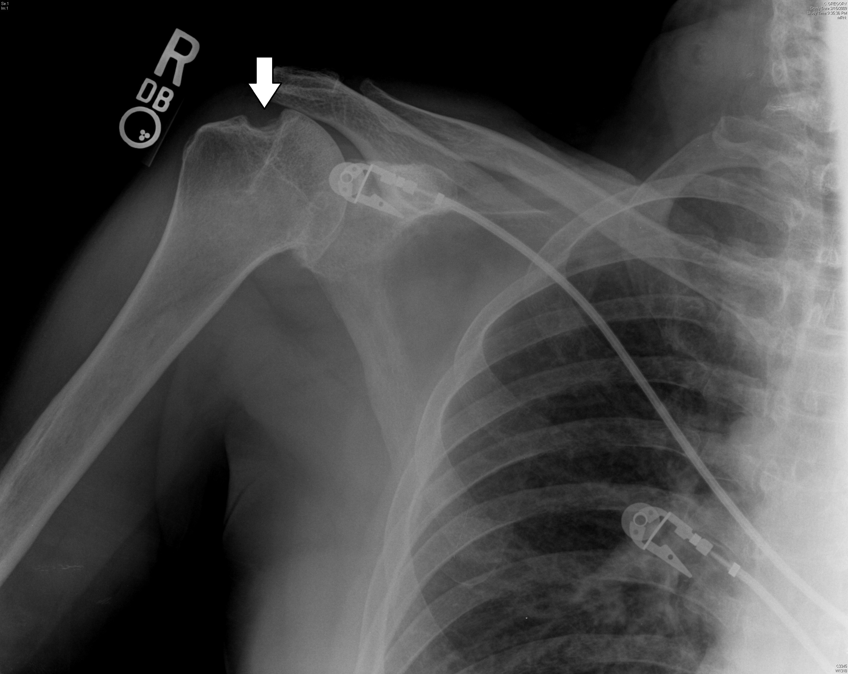 Chronic Hill-Sachs deformity