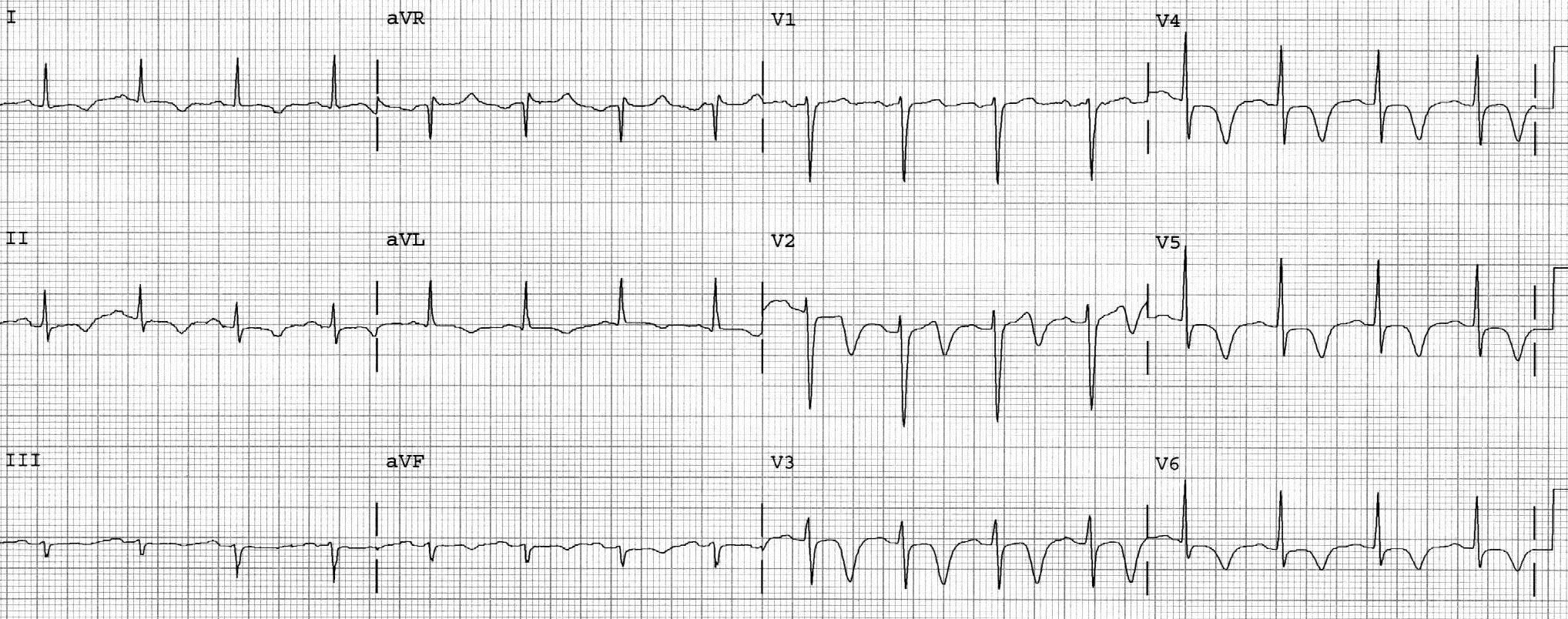 ECG SAH
