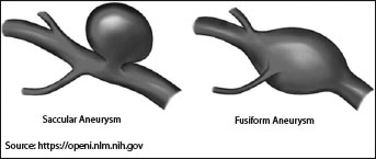types of aneurysms