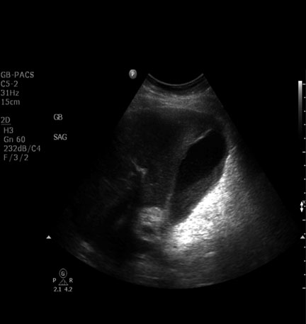 biliary sludge