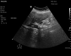 choledocholithiasis