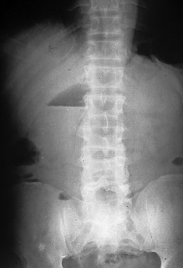 emphysematous cholecystitis plain film