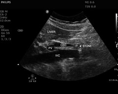 choledocholithiasis