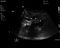choledocholithiasis