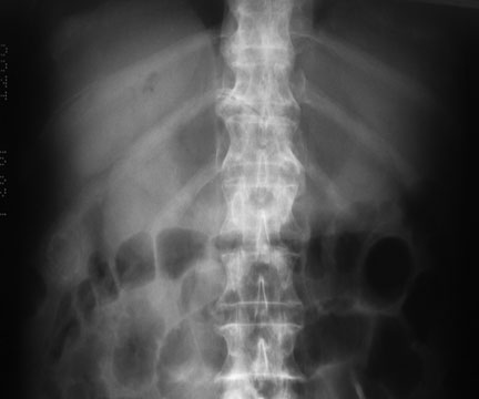 gallstone ileus plain film