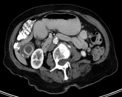 gallstones on CT