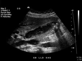 multiple gallstones