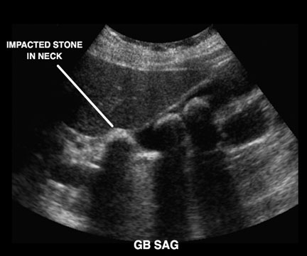 gallstone impacted