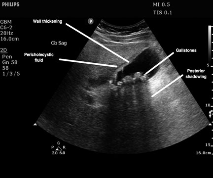 acute cholecystitis