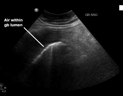 emphysematous cholecystitis