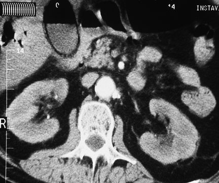 emphysematous cholecystitis
