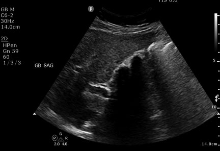 multiple stones within contracted gallbladder
