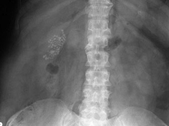 multiple gallstones plain film