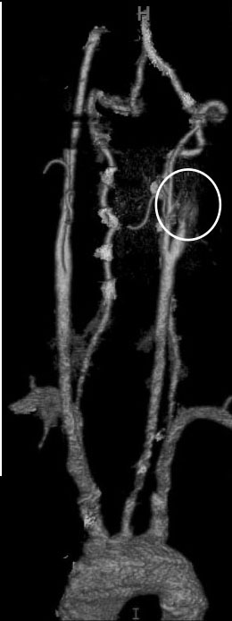 carotid artery with dissection and occlusion