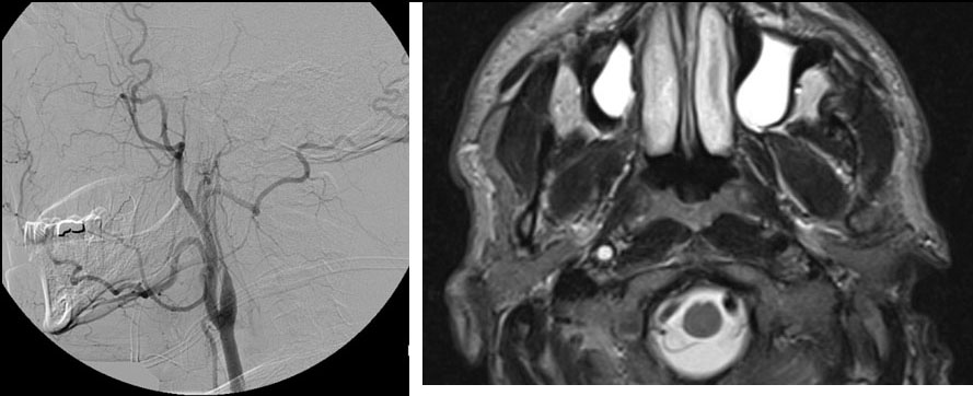 internal carotid artery occlusion