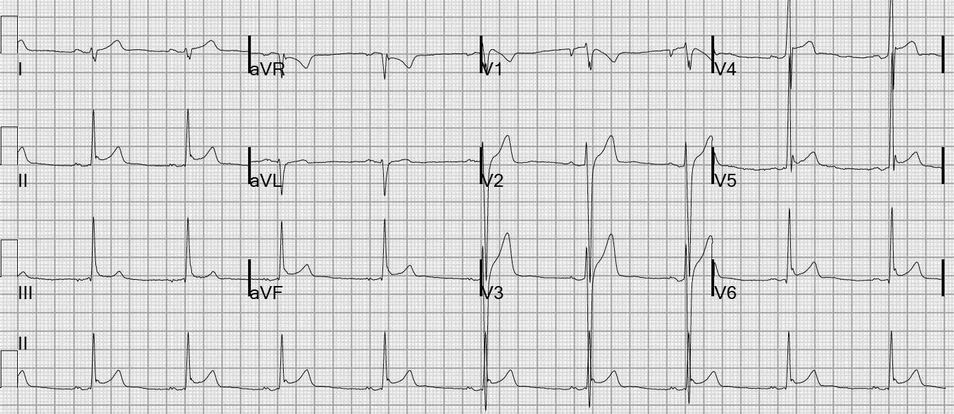 figure 1 early repolarization