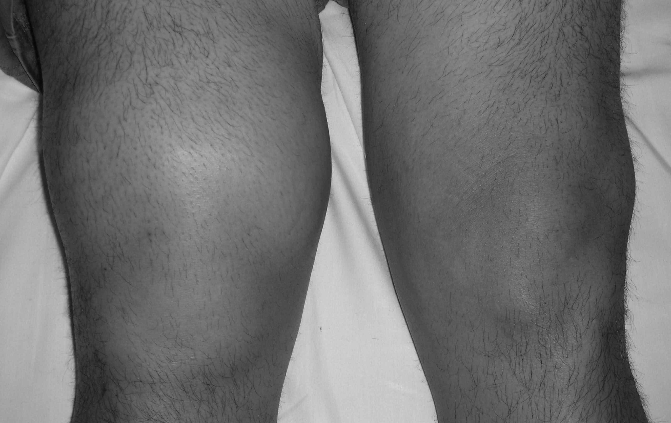 knee effusion