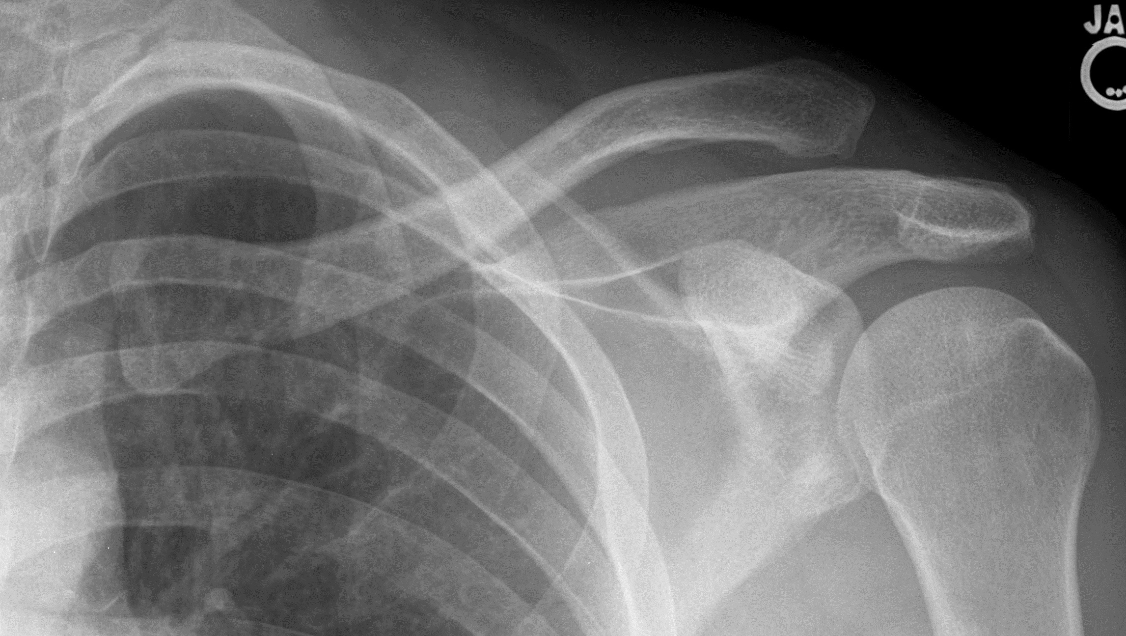 Left type III AC separation