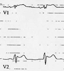 figure type 2 Brugada