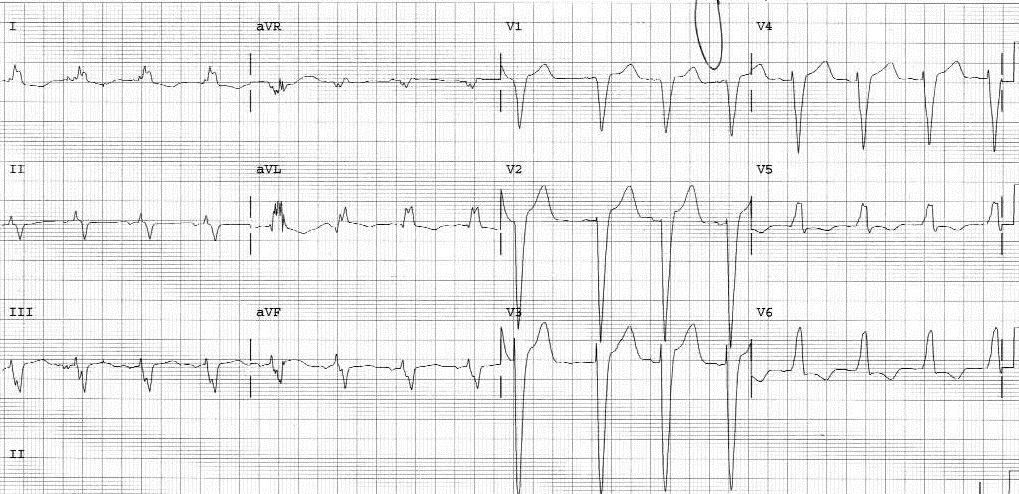 figure 3 left bundle branch block