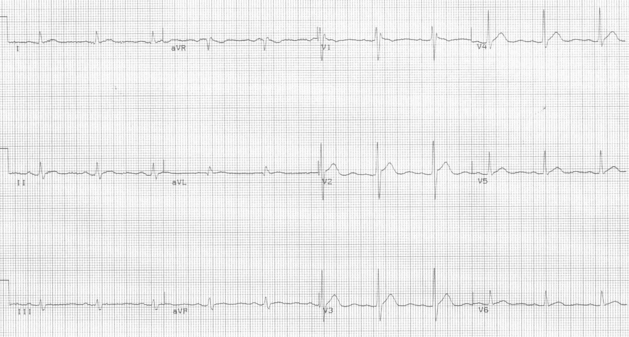 figure 6 hypercalcemia