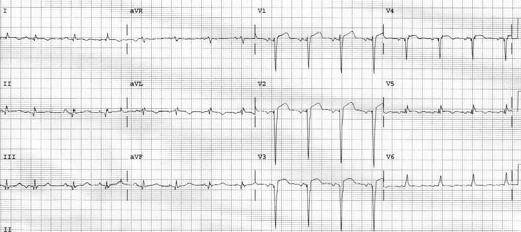 figure 9 left ventricular aneurysm
