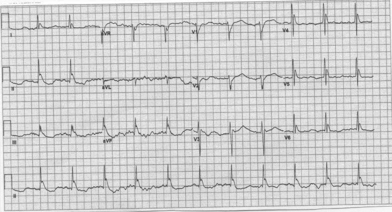 figure 12 Osborn waves