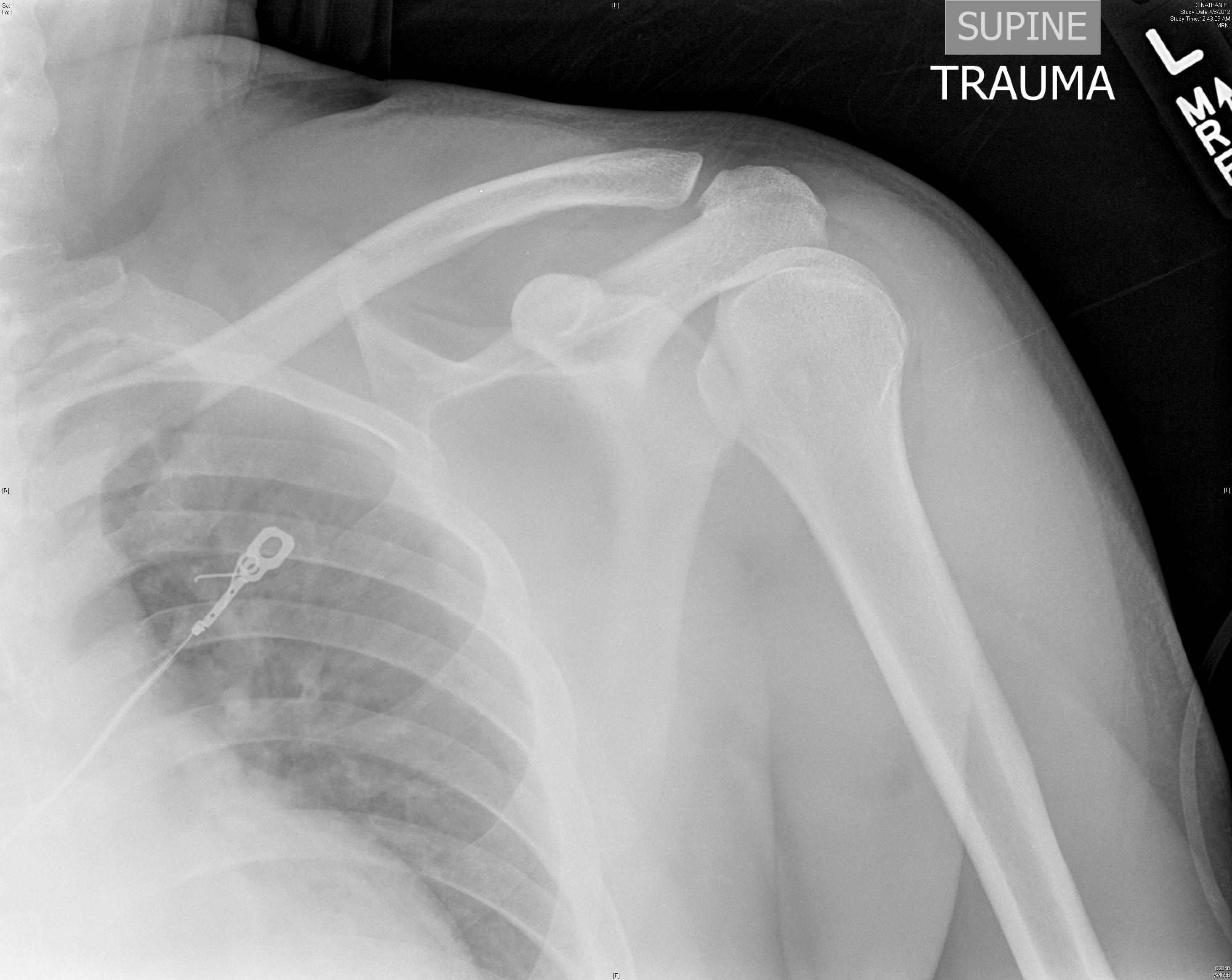 Posterior shoulder dislocation