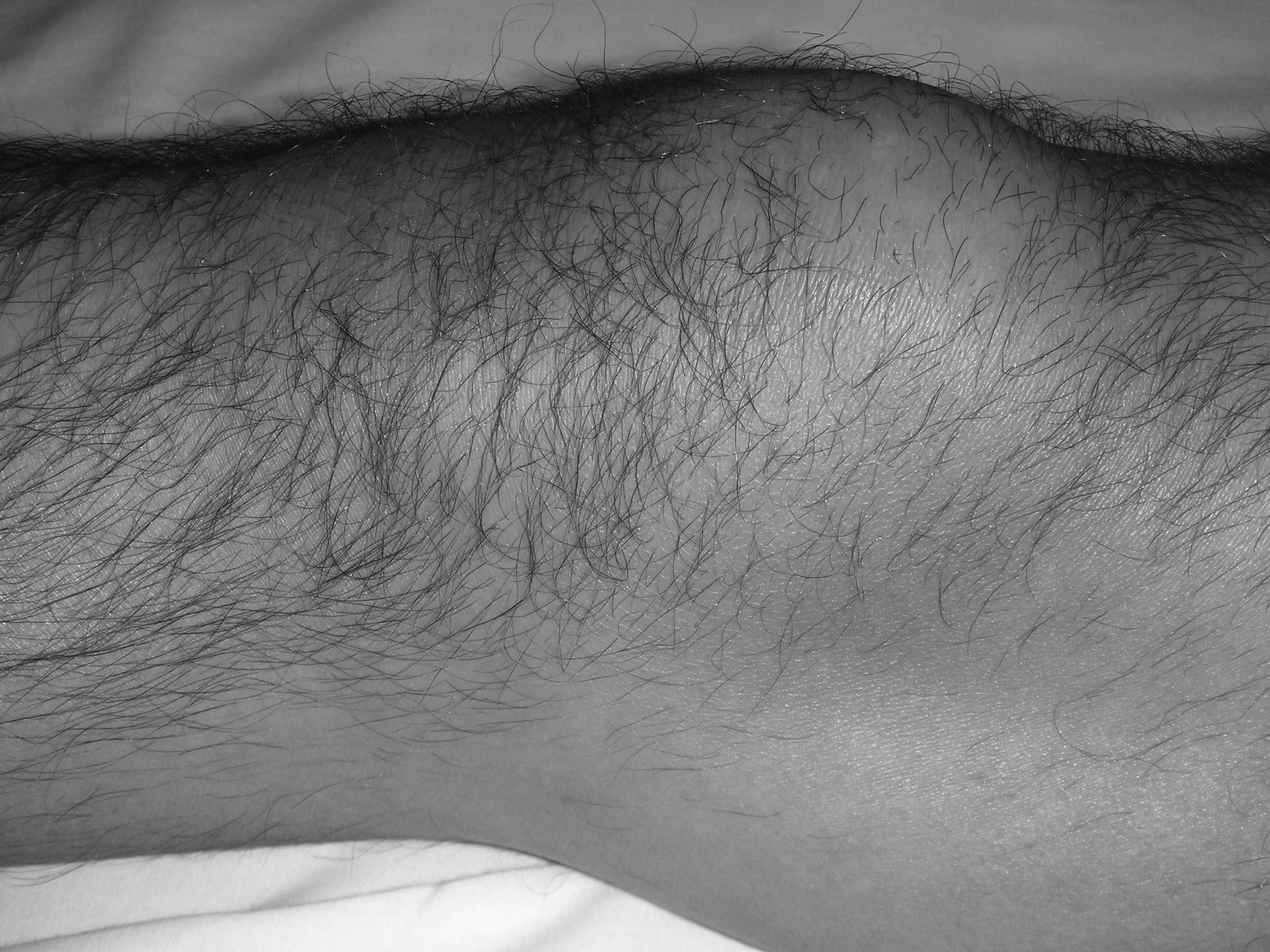 prepatellar bursitis