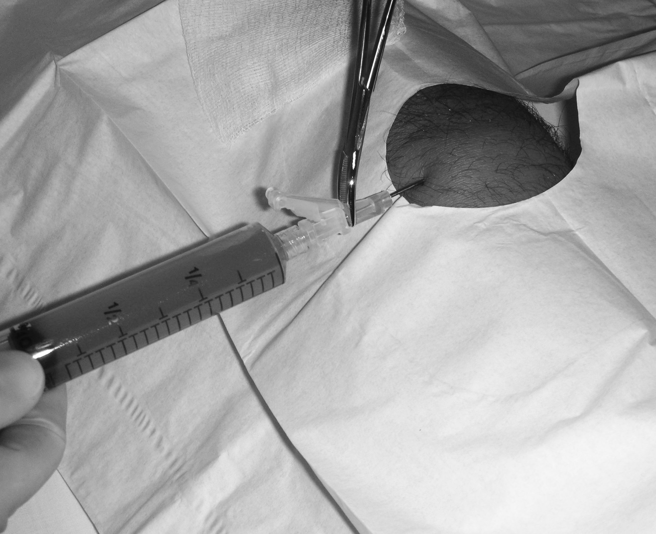 prepatellar bursitis aspiration