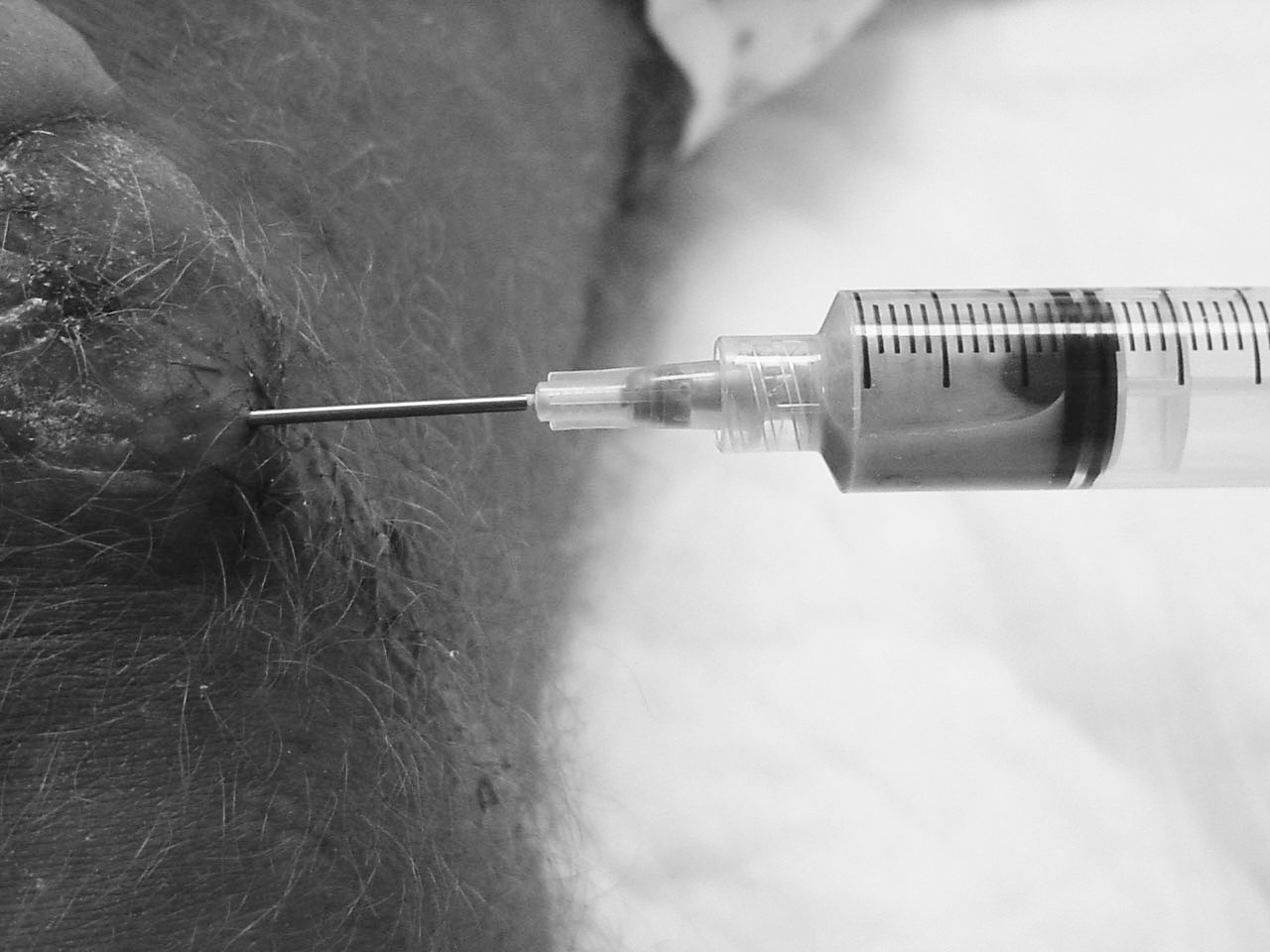 prepatellar septic bursitis aspiration