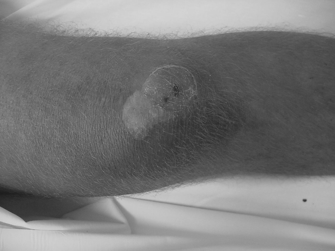 prepatellar septic bursitis