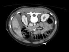 CT liver