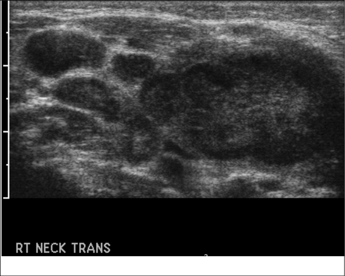 CERVICALADENITIS.tif