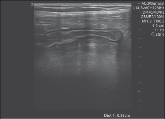 Figure 1: Appendicitis