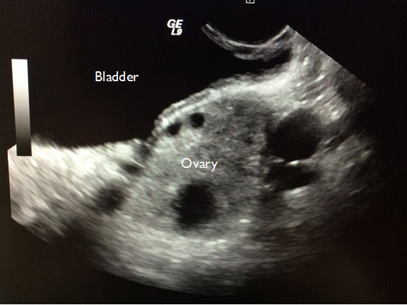 Figure 3B: Ovarian Torsion
