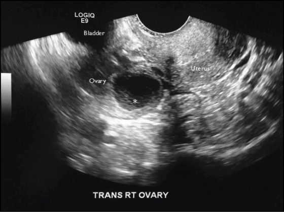 Figure 4A: Hemorrhagic Cyst