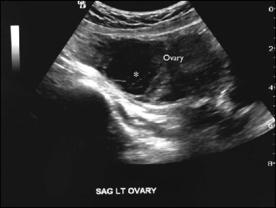 Figure 4B: Hemorrhagic Cyst