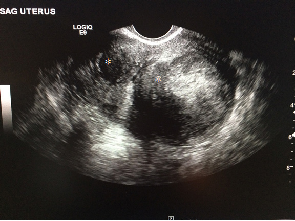 Figure 7: Uterine Fibroids